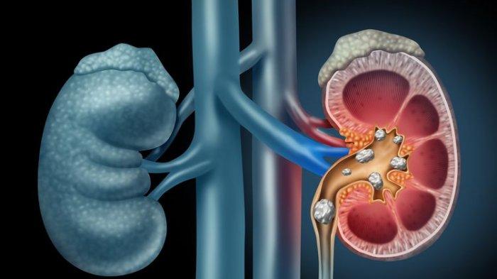 Harus Seberapa Sering Minum Air Putih Biar Tak Kena Batu Ginjal? Idealnya Sih Gini