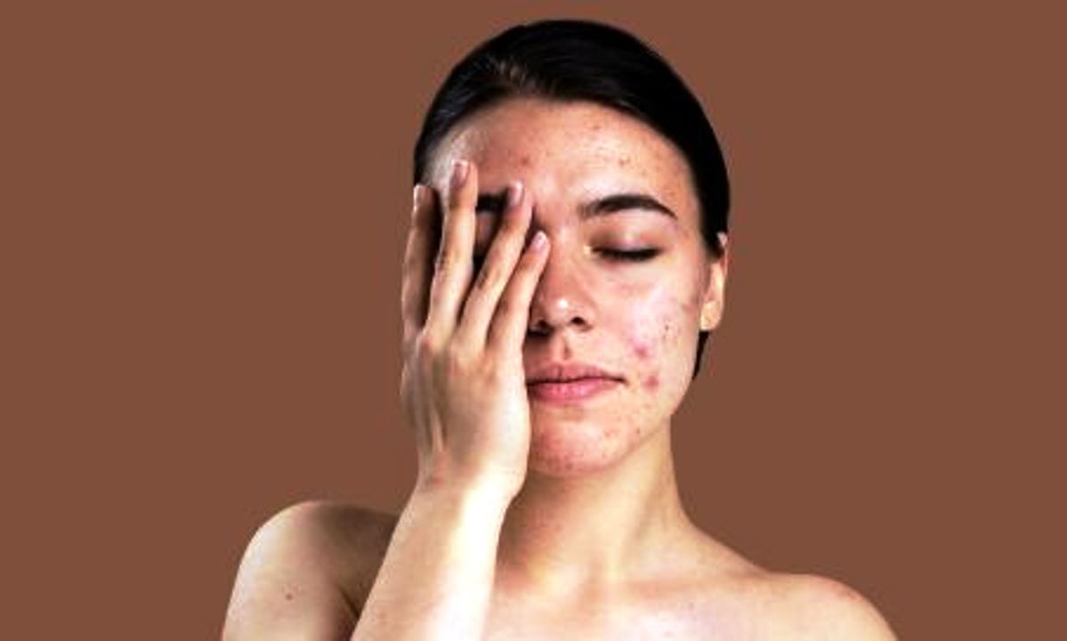 7 Cara yang Ampuh Untuk Mengurangi Rasa Gatal Pada Jerawat, Menurut Para Ahli Dermatologi