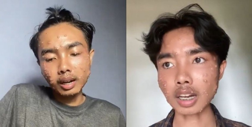 Thrifting Bisa Bikin Kulit Bermasalah? Ini Kisah Nyata dan Tips Aman Memakainya