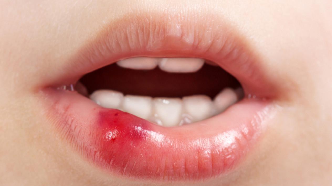 Waspada Sariawan pada Anak! Ini Deretan Bahan Alami yang Ampuh Mengobatinya Tanpa Efek Samping