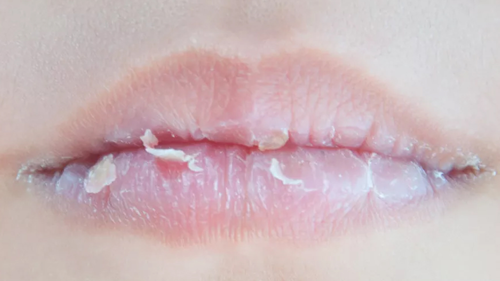 Cara Mengatasi Bibir Pecah-Pecah: Tips dan Perawatan