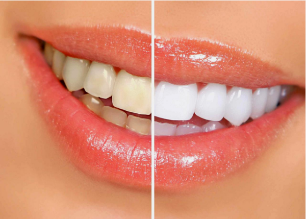 5 Cara Memutihkan Gigi Kuning secara Alami dan Berkilau