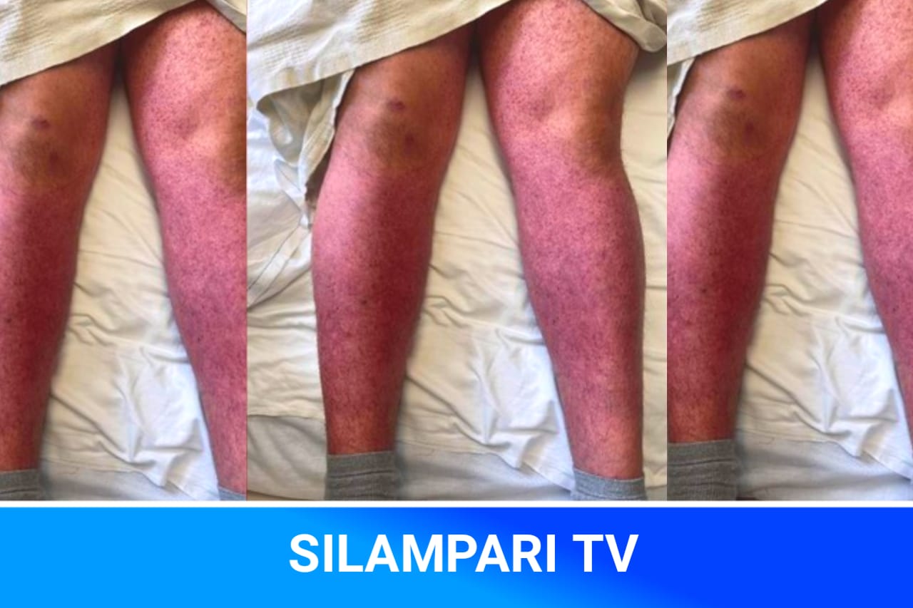 Minum Obat Kuat Sembarangan, Tubuh Pria Ini Berubah Ungu karena Trombosit Turun Drastis.