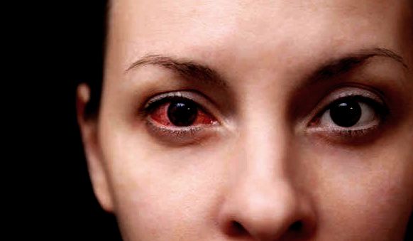 8 Penyebab Mata Sering Gatal dan Cara Mengatasinya!