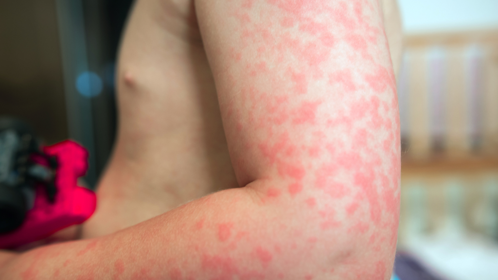 Jenis-Jenis Alergi yang Bisa Pengaruhi Kondisi Tubuh: Dari Makanan hingga Debu di Sekitar Kita