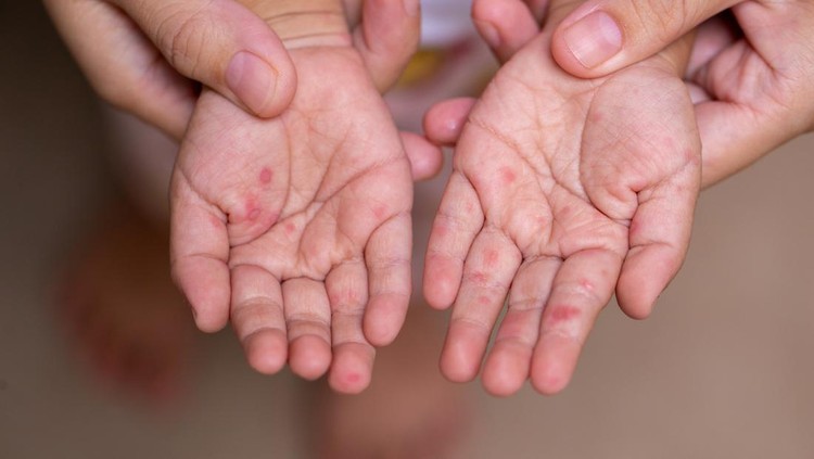 Jangan Salah Kenali, Ini Perbedaan Gatal Campak dan Cacar Air yang Perlu Diketahui Orang Tua