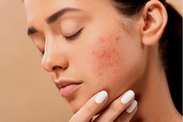 Wajah Rentan Berjerawat? Coba 5 Tips Atasi Acne Prone Skin yang Tak Kunjung Usai