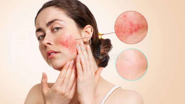 5 Langkah Efektif Mengatasi Alergi Kulit karena Skincare yang Tidak Sesuai