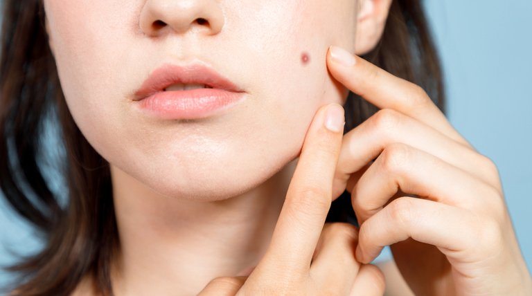 8 Bahan Skincare untuk Menghilangkan Bekas Jerawat, Diakui Dokter Kulit