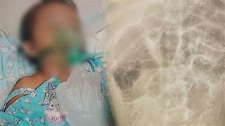 Kasus Raya Bocah Sukabumi, Cermin Ketidakadilan Sistem Kesehatan Nasional