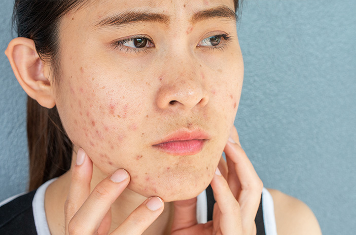 4 Cara Mudah Merawat Acne Prone Skin Agar Terbebas dari Jerawat yang Mengganggu