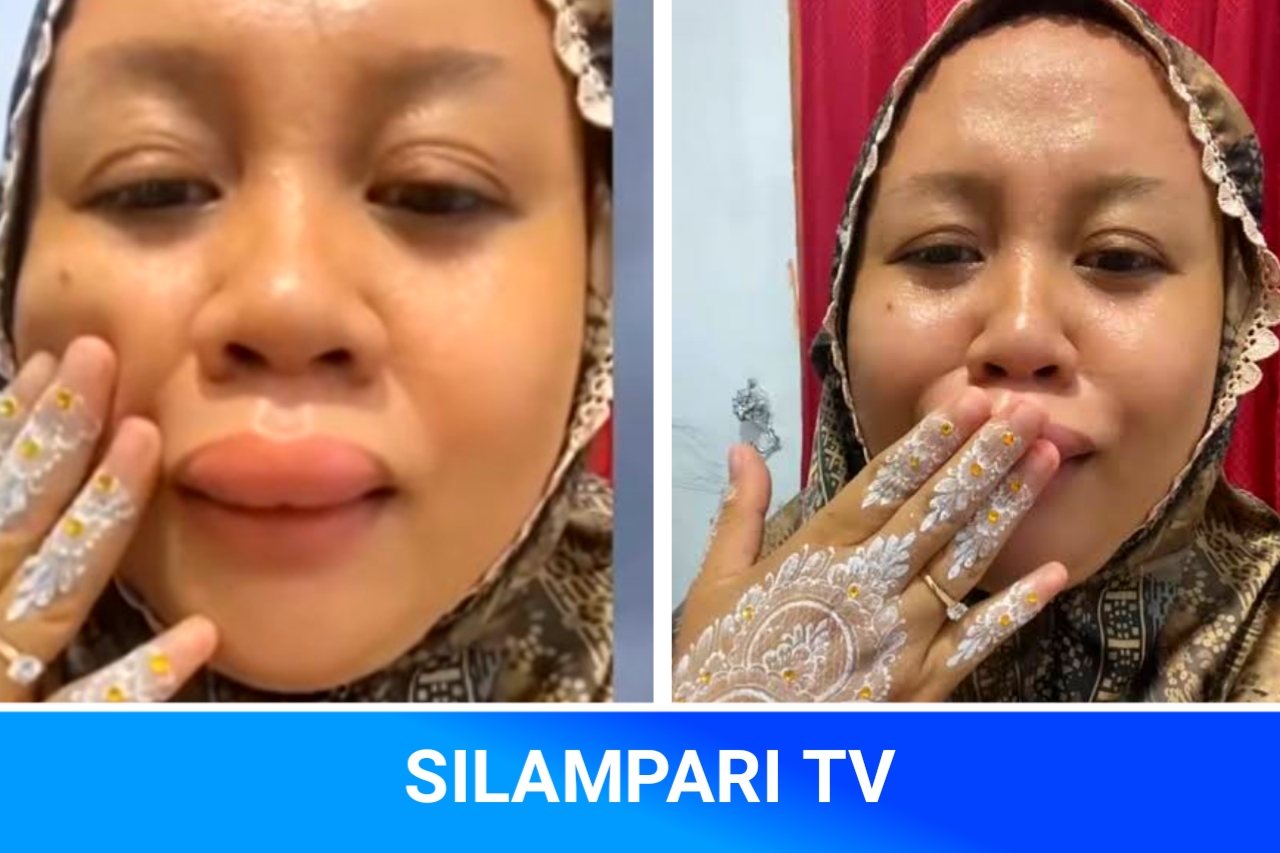 Nasib Apes Jelang Pernikahan, Bibir Wanita Ini Tiba-Tiba Membengkak dan Viral.