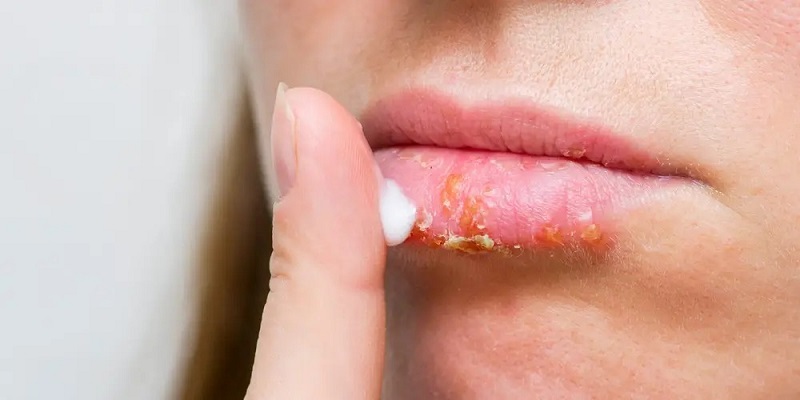 Ini 4 Penyebab Bibir Pecah-Pecah yang Perlu Diwaspadai