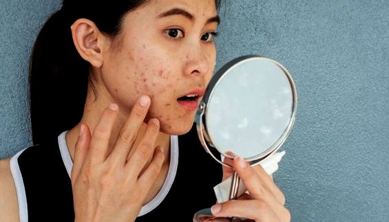 7 Makanan Penyebab Jerawat yang Perlu Dihindari agar Kulit Tetap Bersih dan kinclong