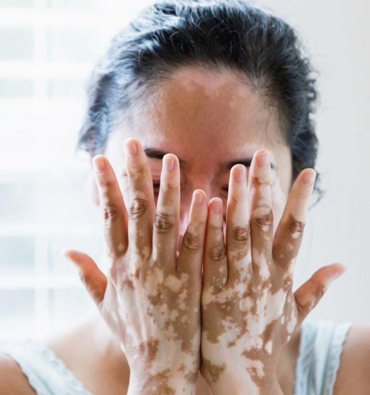 Cara Perawatan Vitiligo Salah Satunya Pengunaan Sunscreen