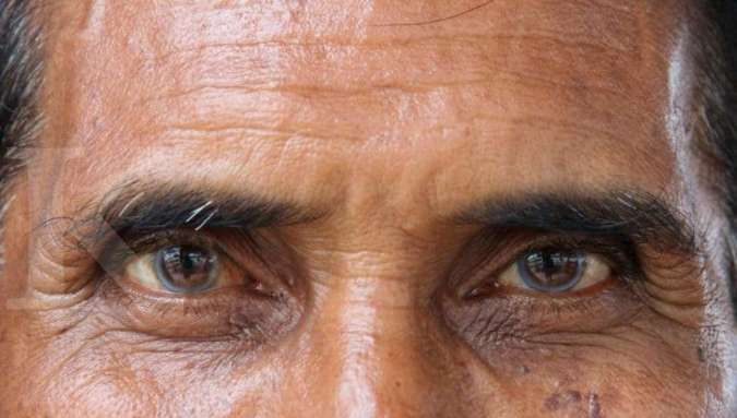 Waspada Katarak pada Lansia: Kenali Penyebab dan Cara Mencegahnya Sejak Dini