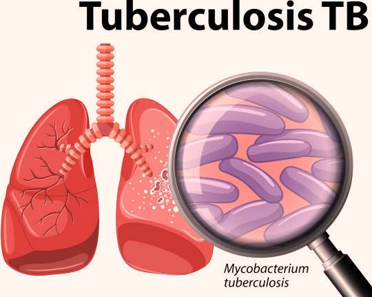 Darurat Tuberkulosis di Indonesia: 14 Nyawa Melayang Setiap Jam