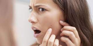 7 Tips Merawat Kulit Remaja Agar Bebas Jerawat dan Tetap Sehat