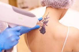Risiko Efek Samping Yang Perlu Diwaspadai Setelah Tattoo Removal