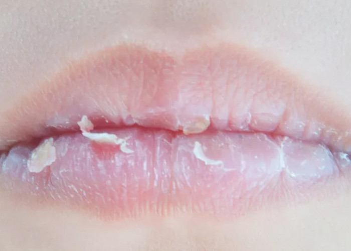 Cara Mengatasi Bibir Pecah-Pecah: Tips dan Perawatan