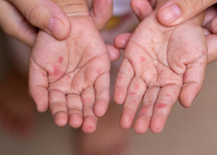 Jangan Salah Kenali, Ini Perbedaan Gatal Campak dan Cacar Air yang Perlu Diketahui Orang Tua