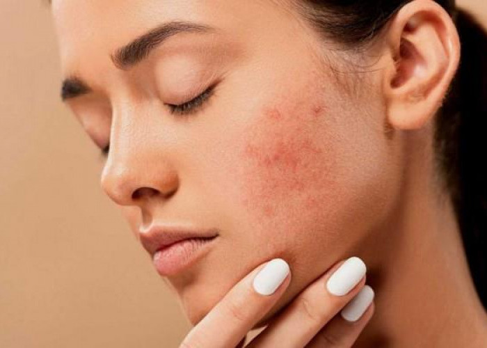 Wajah Rentan Berjerawat? Coba 5 Tips Atasi Acne Prone Skin yang Tak Kunjung Usai