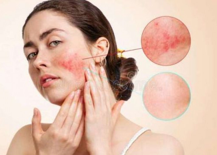 5 Langkah Efektif Mengatasi Alergi Kulit karena Skincare yang Tidak Sesuai