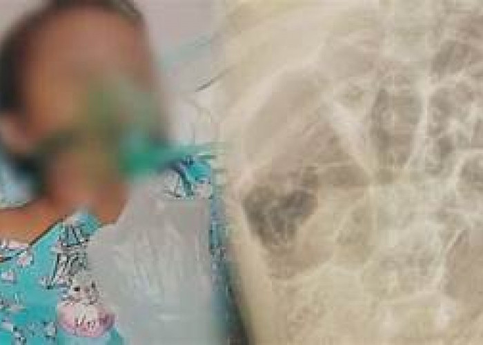 Kasus Raya Bocah Sukabumi, Cermin Ketidakadilan Sistem Kesehatan Nasional