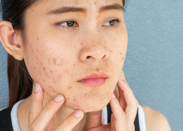 4 Cara Mudah Merawat Acne Prone Skin Agar Terbebas dari Jerawat yang Mengganggu