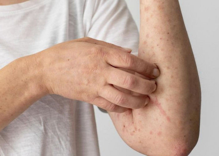 Kasus Campak Masih Tinggi, Kemenkes Ingatkan Risiko Infeksi Ulang dan Pentingnya Vaksinasi