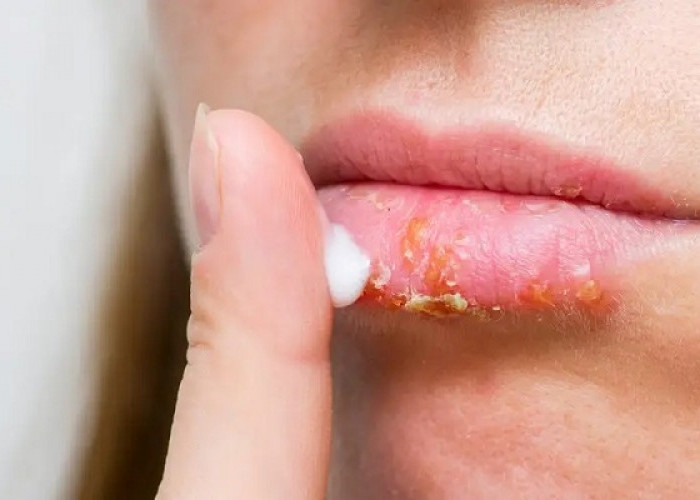 Ini 4 Penyebab Bibir Pecah-Pecah yang Perlu Diwaspadai