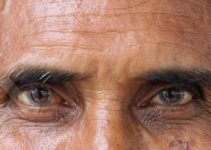 Waspada Katarak pada Lansia: Kenali Penyebab dan Cara Mencegahnya Sejak Dini