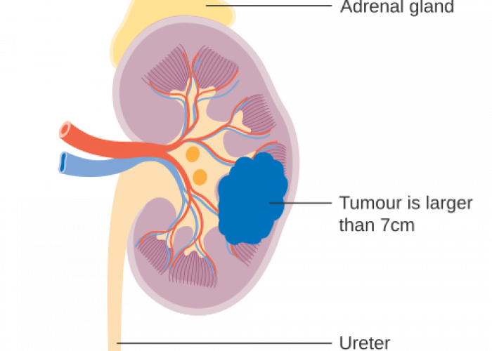 Kanker Ginjal Sulit Terdeteksi Dini, Ini Penjelasan di Balik Penyakit yang Diidap Vidi Aldiano