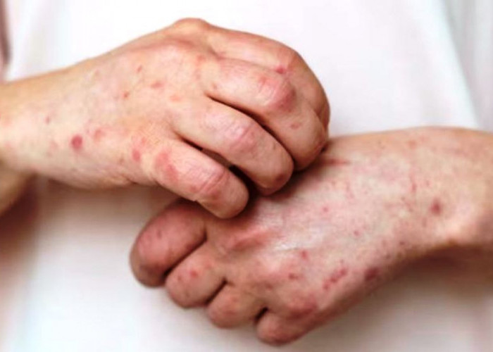10 Penyebab Bintik Merah di Tangan, Berikut Ini Cara Pengobatannya!