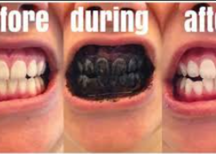 Mitos atau Fakta? Mengulas Kemungkinan Memutihkan Gigi dengan Gosok Gigi Arang