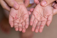 Jangan Salah Kenali, Ini Perbedaan Gatal Campak dan Cacar Air yang Perlu Diketahui Orang Tua