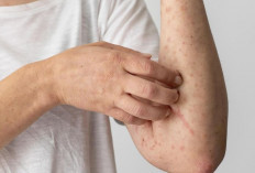 Kasus Campak Masih Tinggi, Kemenkes Ingatkan Risiko Infeksi Ulang dan Pentingnya Vaksinasi