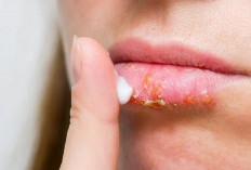 Ini 4 Penyebab Bibir Pecah-Pecah yang Perlu Diwaspadai