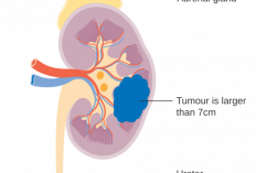Kanker Ginjal Sulit Terdeteksi Dini, Ini Penjelasan di Balik Penyakit yang Diidap Vidi Aldiano